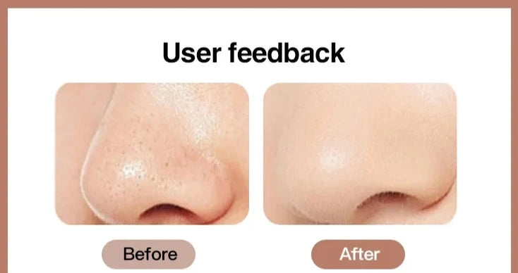 Ultrasonic Blackhead Remover